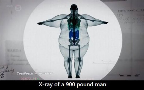 چاق ترین مرد دنیا زیر اشعه ایکس