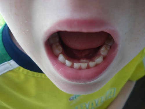 7 مشکل دندان در حوالی 7 سالگی