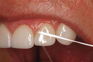 استفاده از نخ دندان,کشیدن نخ دندان,جایگزین نخ دندان