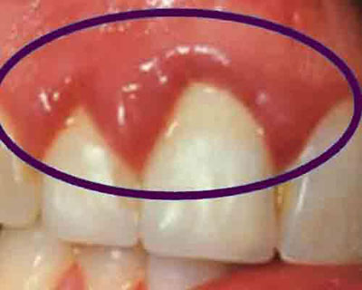 نشانه‌های بیماری لثه, بهداشت دهان و دندان