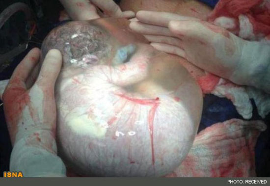 تولد یک نوزاد درون کیسه آب +عکس