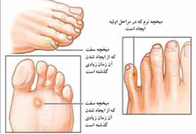  ضایعه پوستی, علل ایجاد میخچه