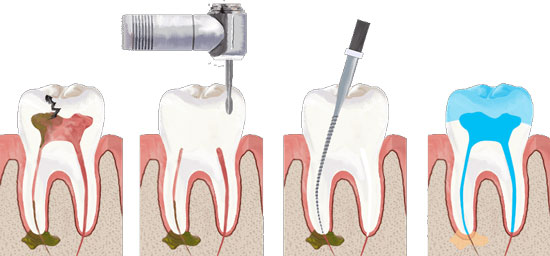 پنج سوالی که درباره عصب کشی دندان می پرسند