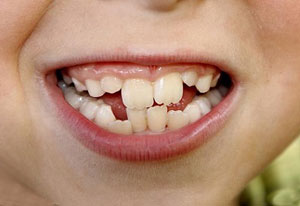 دندان,دلیل کج رشد کردن دندان,دندانهای آسیاب