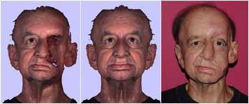 تولید اجزای چهره بیمار سرطانی با پرینت سه بعدی