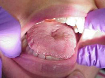 التهاب‌ حاد زبان, كم‌خونی‌, آلرژیهای غذایی