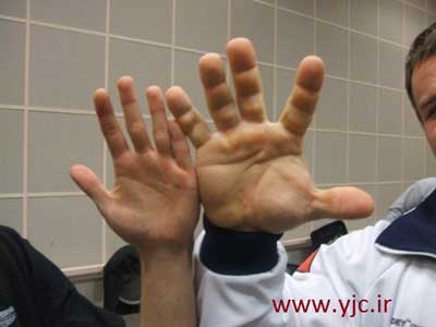 بزرگترین دست های دنیا,اندازه دست یک فرد سالم و بالغ, دنیس سایپلنکوو