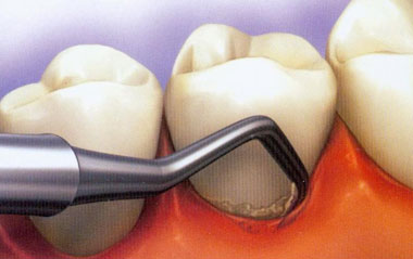 دندان,پوسیدگی دندان, علت لق شدن دندان
