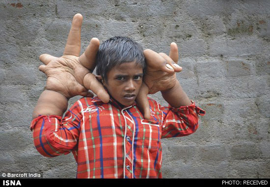 پسربچه‌ هندی با دست‌های غول‌آسا +عکس