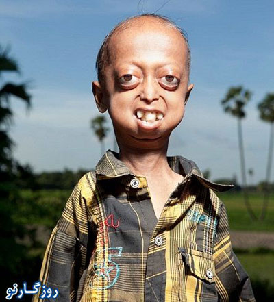 بیماری های نادر ژنتیکی,علائم بیماری Progeria