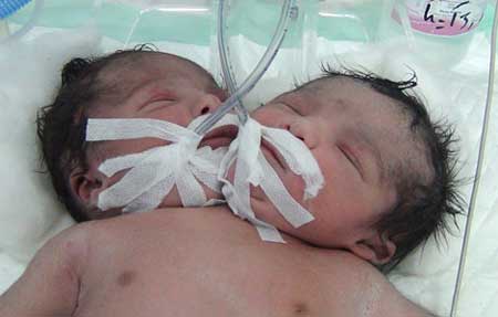تولد نوزادی دو سر در دزفول 