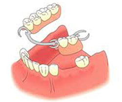 دندان مصنوعی ناکامل