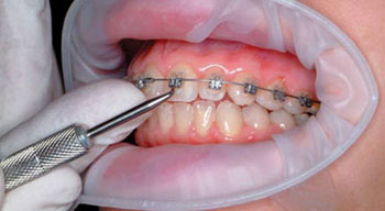 ارتودنسی های نامرئی, درمان های ارتودنسی, پوسیدگی دندان