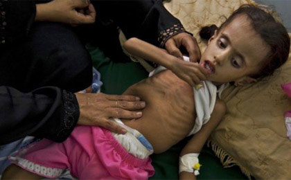 سوء تغذیه؛ قاتل اصلی کودکان در جهان