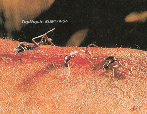 استفاده از مورچه ها برای بخیه زدن زخم