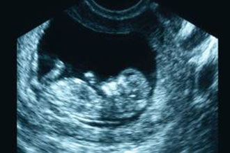 سونوگرافی در 3 ماه اول بارداری,سونوگرافی سه ماهه سوم بارداری