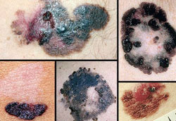 ملانوما,علائم سرطان پوست,نشانه های سرطان پوست