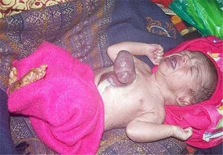 اخبار,اخبار گوناگون , تولد نوزاد هندی با قلبی خارج از بدن
