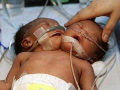 تولد نوزاد دو سر در برزیل + عکس 