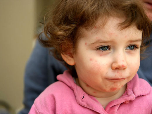 8 روش پیشگیری از مریض شدن بچه‌ها در نوروز+درمان