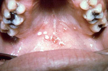  بیماری‌های عفونی, التهاب ویروسی دهان