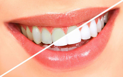 راه حل‌های خانگی سفید کردن دندانها, بهداشت دهان و دندان
