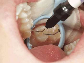 دندان دائمی, فیشورسیلنت, فیشور سیلنت چیست