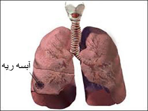 آبسه ریه , عفونت ریه , عامل آبسه ریه