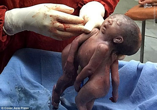 عکس/ تولد نوزاد دوقلو با یک صورت