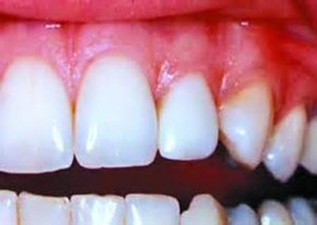 آبسه دندان,درمان آبسه دندان,آبسه کردن دندان