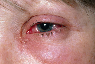 بیماری‌های چشمی, آب سیاه چشم