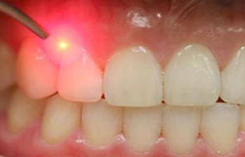 آبسه دندان,علائم آبسه دندان,آبسه دهان و دندان
