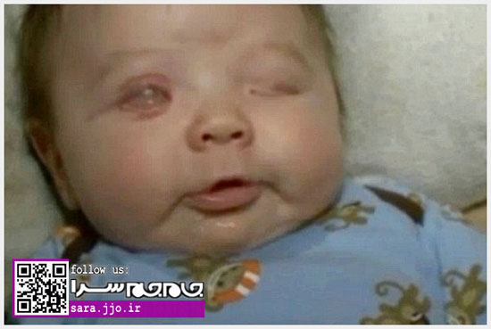 تولد نوزاد بدون چشم در آمریکا [+عکس]