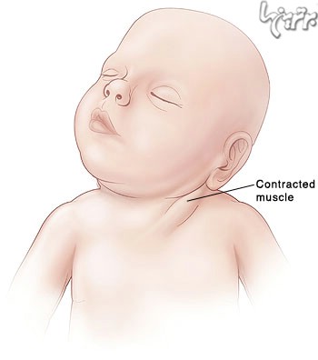 تورتیکولی یا کج گردنی نوزاد چیست؟