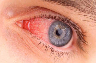 ترشحات چرکی چشم, علایم عفونت چشم