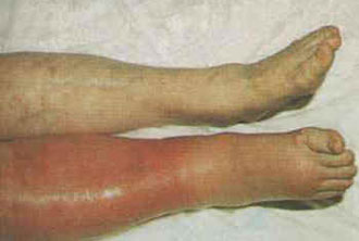 ترومبوز وریدهای عمقی, تجمع خون در پا