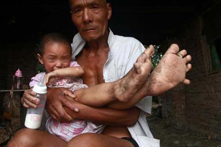 اخبار ,اخبار علمی ,دختری که پاهایش شبیه دستانش است