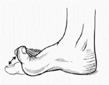 کف پای صاف,درمان کف پای صاف,حرکات اصلاحی کف پای صاف