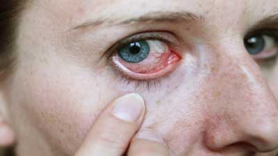 حساسیت‌های چشمی, آلرژی چشم, قرمزی چشم