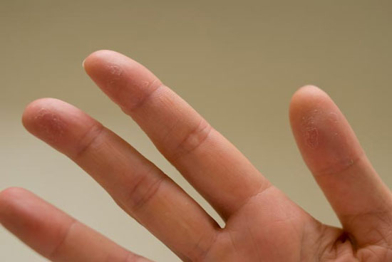 علل پوسته پوسته شدن نوک انگشتان دست