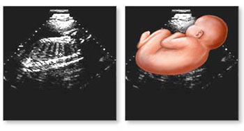 سونوگرافی از جنین,سونوگرافی در بارداری,سونوگرافی در بارداری