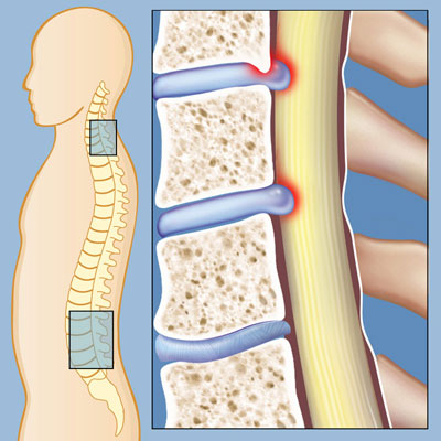 استخوان سازی, علایم تنگی کانال نخاعی